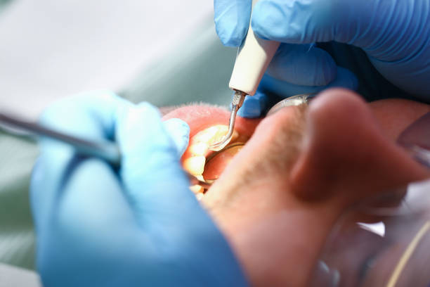 Best Emergency Dental Care for Broken or Chipped Teeth in Pittsboro, NC