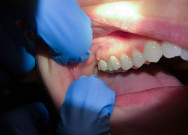 Best Emergency Treatment for Dental Infections or Abscesses in Pittsboro, NC